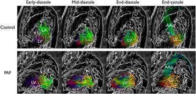 Left Ventricular Flow Distribution as a Novel Flow Biomarker in Atrial Fibrillation